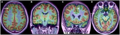 Hypometabolic patterns of focal cortical dysplasia in PET-MRI co-registration imaging: a retrospective evaluation in a series of 83 patients